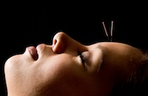 woman with acupuncture needles in her forehead